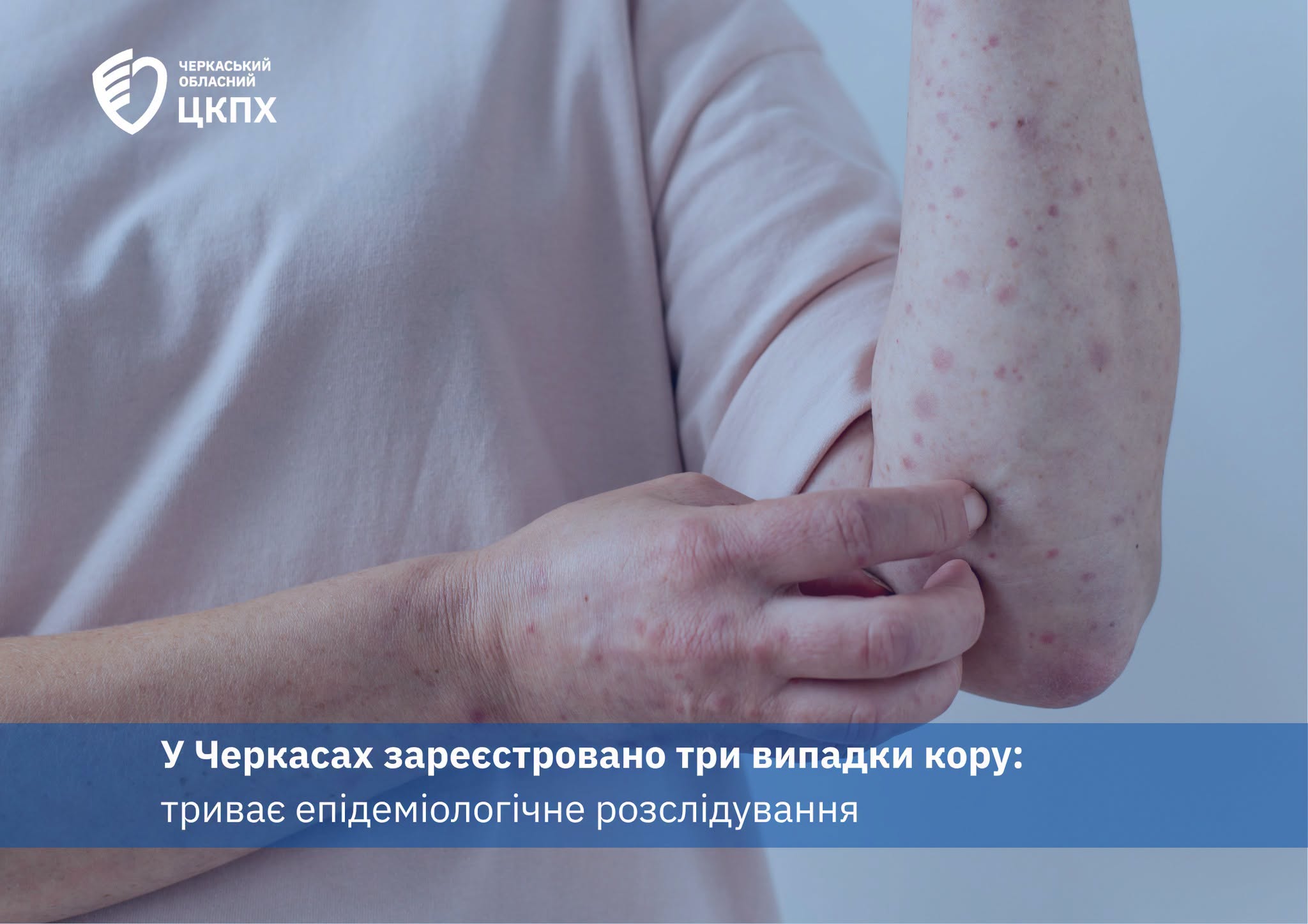 Черкаси: 3 випадки кору. Загроза поширення.
